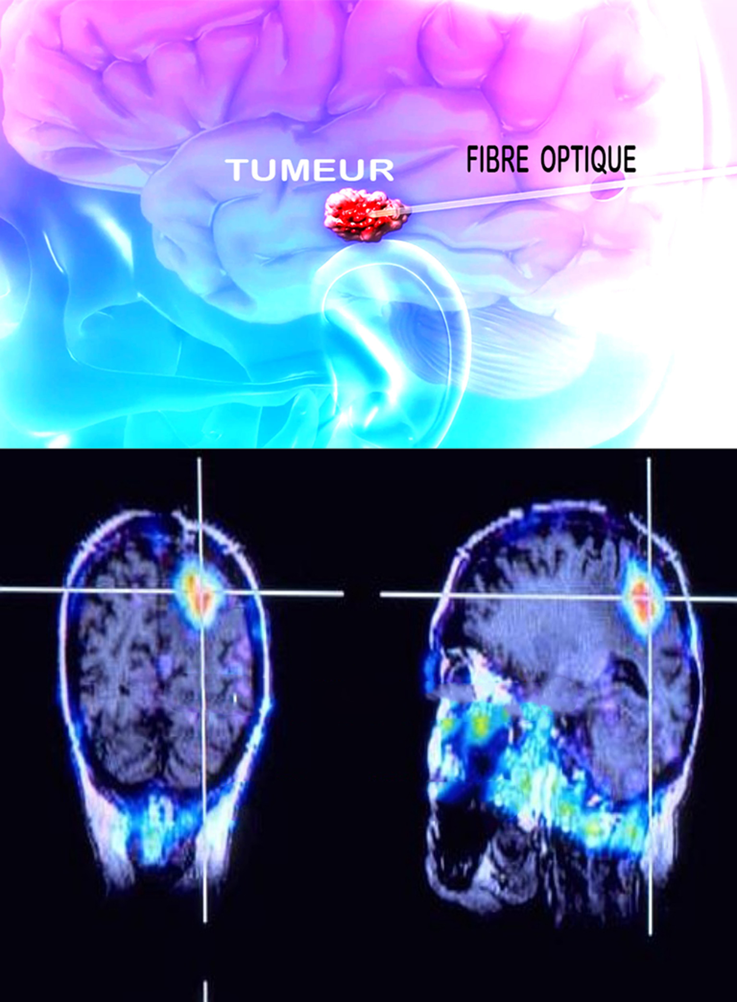 Traitement lasers dans les tumeurs cerebrales - formation lasers ...